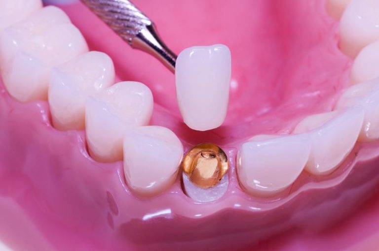 Dental Porcelain Crowns in Nassau, Bahamas Bahama Isles Dental Suites